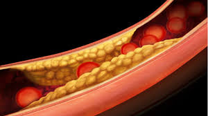 AU Researchers Develop Early Diagnostic Kit For Heart Disease Risk