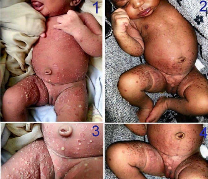 Infant Suffering From Rare Skin Disease Treated In PHC In Bijapur With Modern Treatment, Local Traditional Nursing Practice