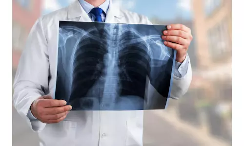 Up To 2.3 Million TB Cases Could Be Averted By Ending Undernutrition: Study