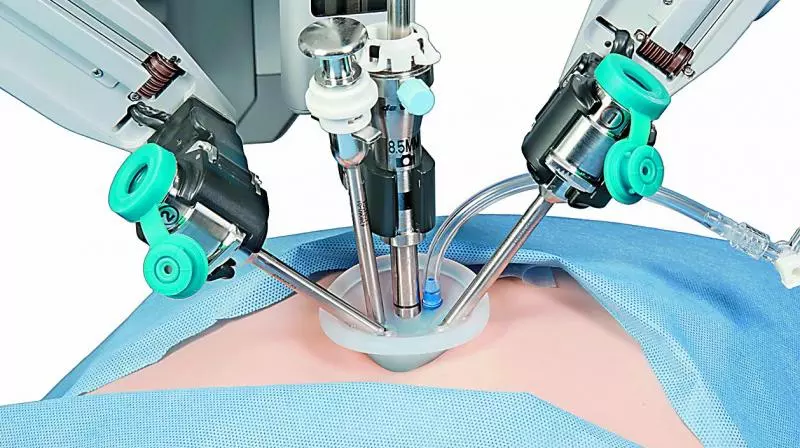 Low Complication Rates in Robotic Surgery For Endometriosis: Hyderabad Doctor’s Study Low Complication Rates in Robotic Surgery For Endometriosis: Hyderabad Doctor’s Study