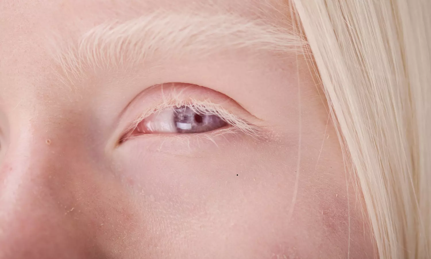 International Albinism Day: Beyond the Medical Lens International Albinism Day: Beyond the Medical Lens