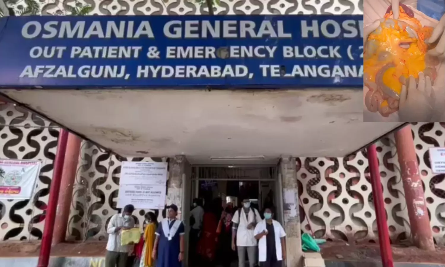 Osmania Hospital Performs India’s First Five-Organ Multi-Visceral Transplant Osmania Hospital Performs India’s First Five-Organ Multi-Visceral Transplant