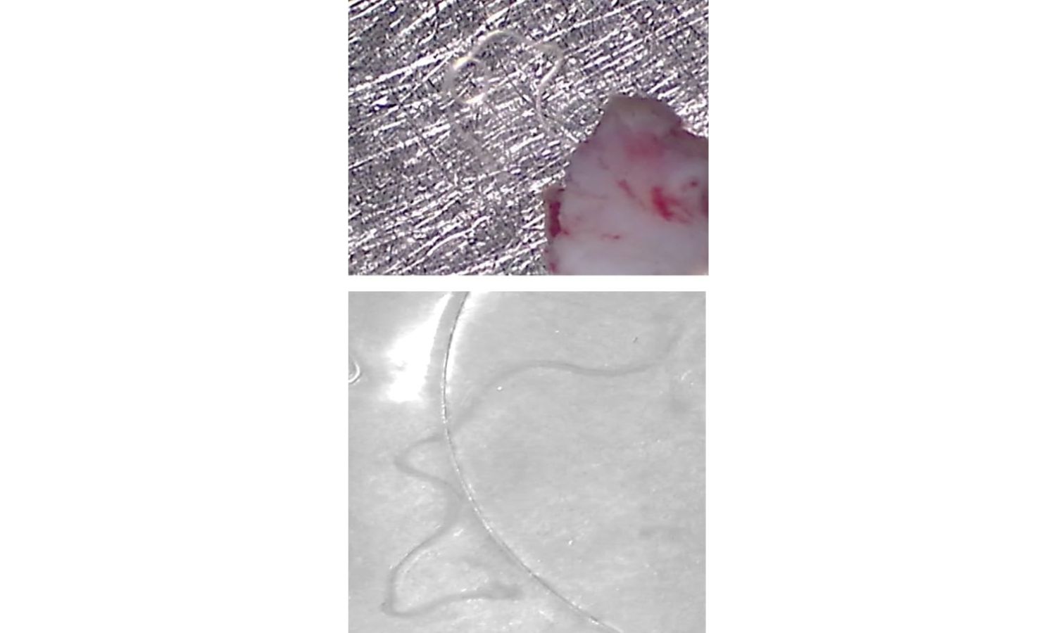 Doctors Remove Live Worm from Child's Eye