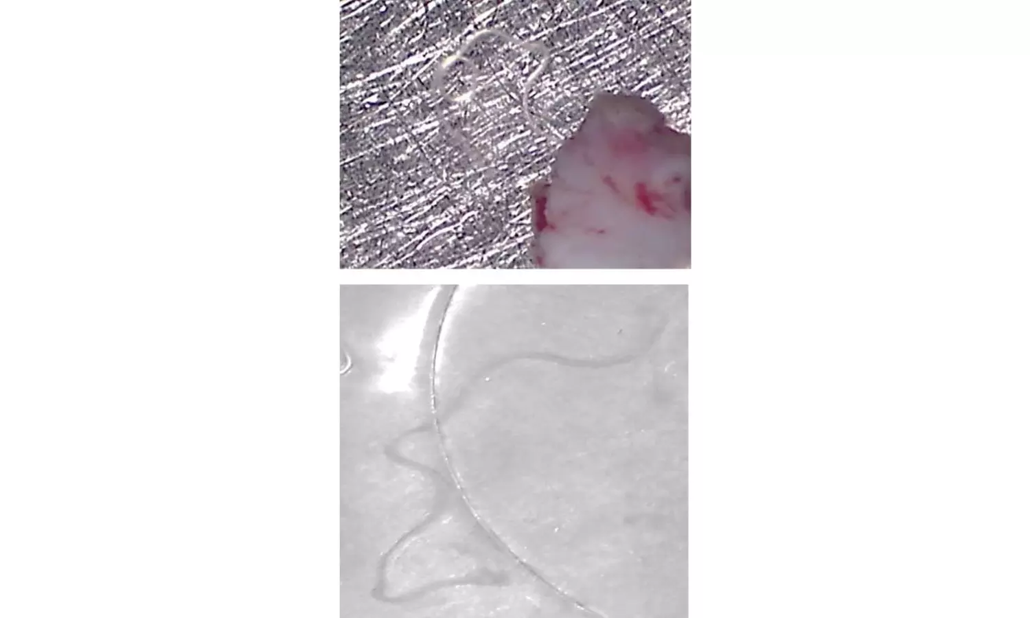 Kasturba Hospital Ophthalmologists Remove Live Worm From Four-year-old Girls Eye Kasturba Hospital Ophthalmologists Remove Live Worm From Four-year-old Girls Eye