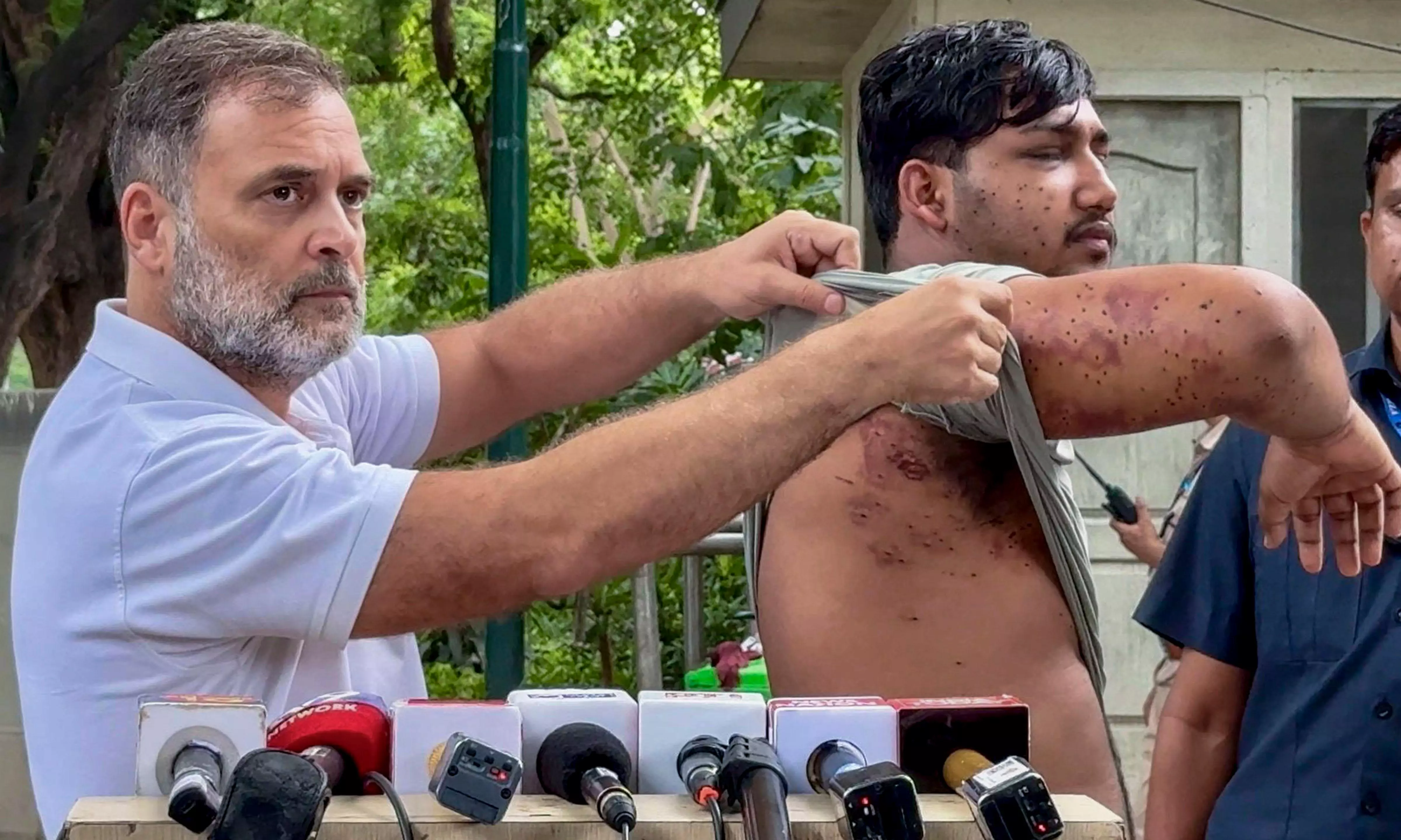 Rahul Shows Pellet Injuries, Demands End to Assault on Students Rahul Shows Pellet Injuries, Demands End to Assault on Students