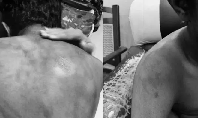 Hyderabad: Class X Student Allegedly Assaulted by Classmates at School Hostel Hyderabad: Class X Student Allegedly Assaulted by Classmates at School Hostel