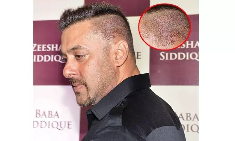 Secret Behind Those Perfect Hairlines Secret Behind Those Perfect Hairlines