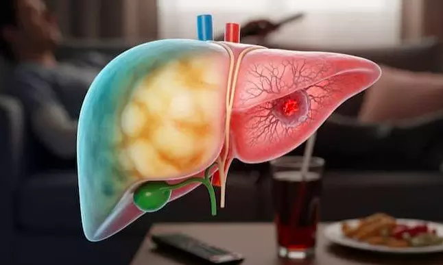 India Faces Rising Burden Of Fatty Liver, Colorectal Cancer: Experts India Faces Rising Burden Of Fatty Liver, Colorectal Cancer: Experts