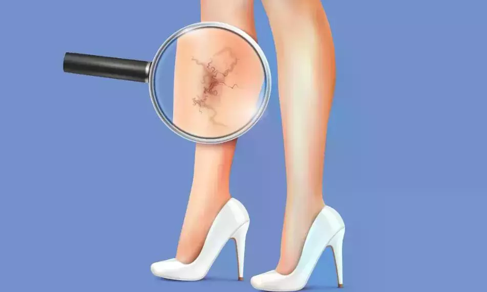 Youngsters, Pregnant Women Need More Precautions Against Varicose Veins Youngsters, Pregnant Women Need More Precautions Against Varicose Veins