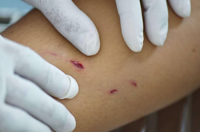 Dispute Erupts Over Soap Used on Dog-Bite Wounds