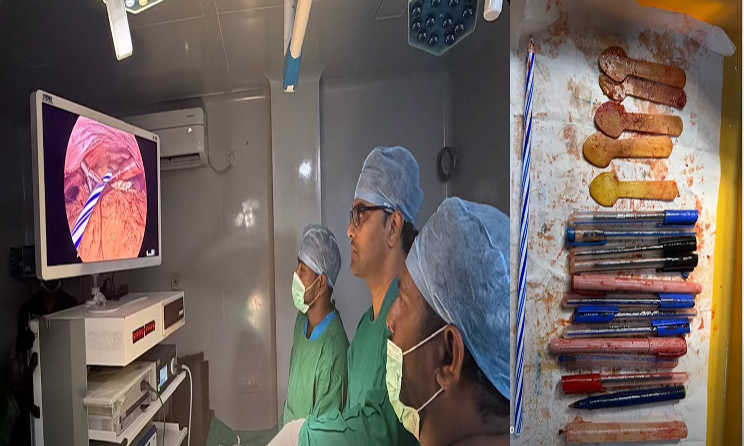 Palnadu: Doctors Pull Out 14 Pens, 5 Spoons, & a Candle from Woman's Stomach