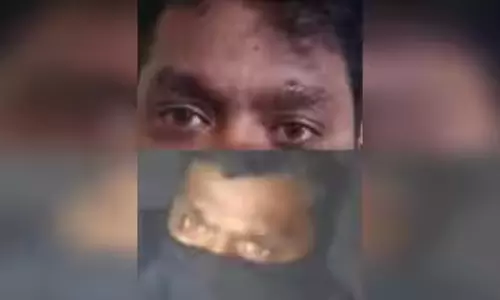 Scar Gives Away Burglar, Held in 48 Hours Scar Gives Away Burglar, Held in 48 Hours