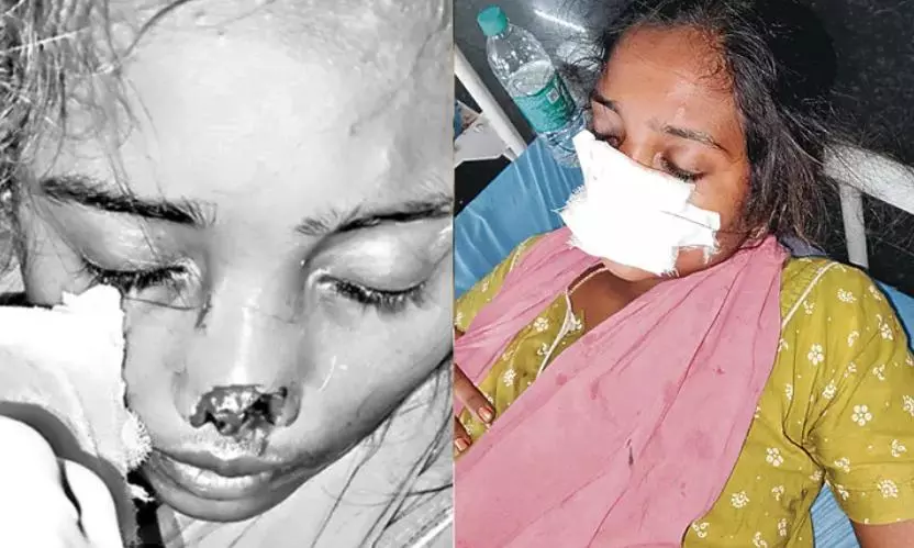 Man Bites Wife’s Nose After Dowry Dispute In Mancherial Man Bites Wife’s Nose After Dowry Dispute In Mancherial