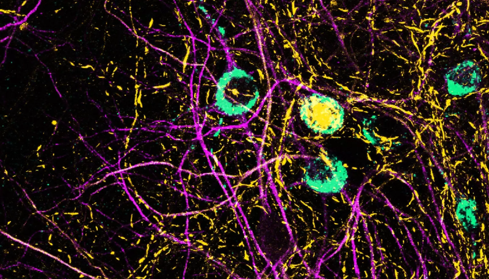 Viral RNA May Trigger Molecular Changes Linked to Parkinson’s, Hyderabad Study Finds Viral RNA May Trigger Molecular Changes Linked to Parkinson’s, Hyderabad Study Finds