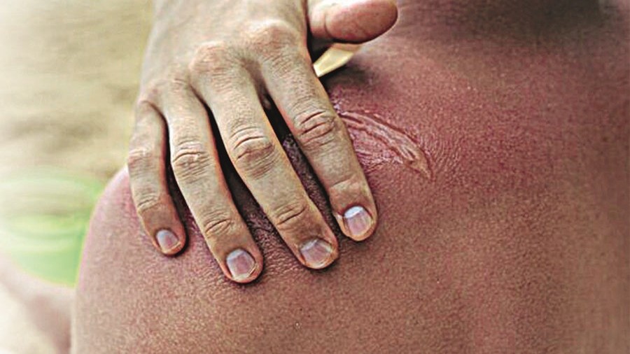 Keloids Often Go Unrecognised in Darker Skin